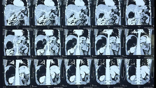 Adrenal Tumor
